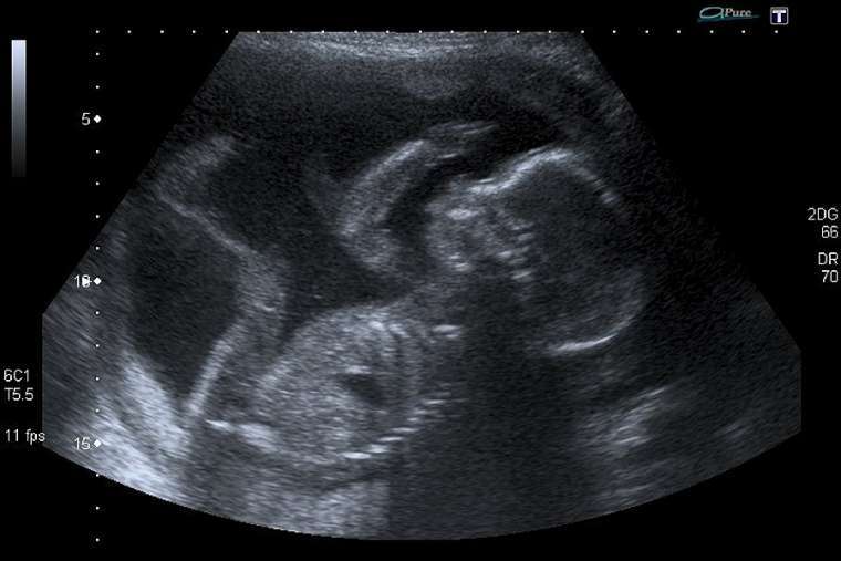 “Il feto nell’utero materno è UNA PERSONA”: in Alabama l’aborto è illegale